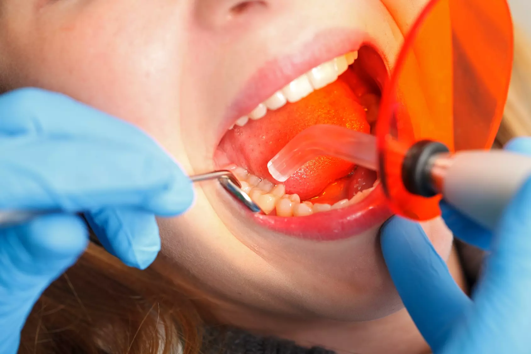 dental filling