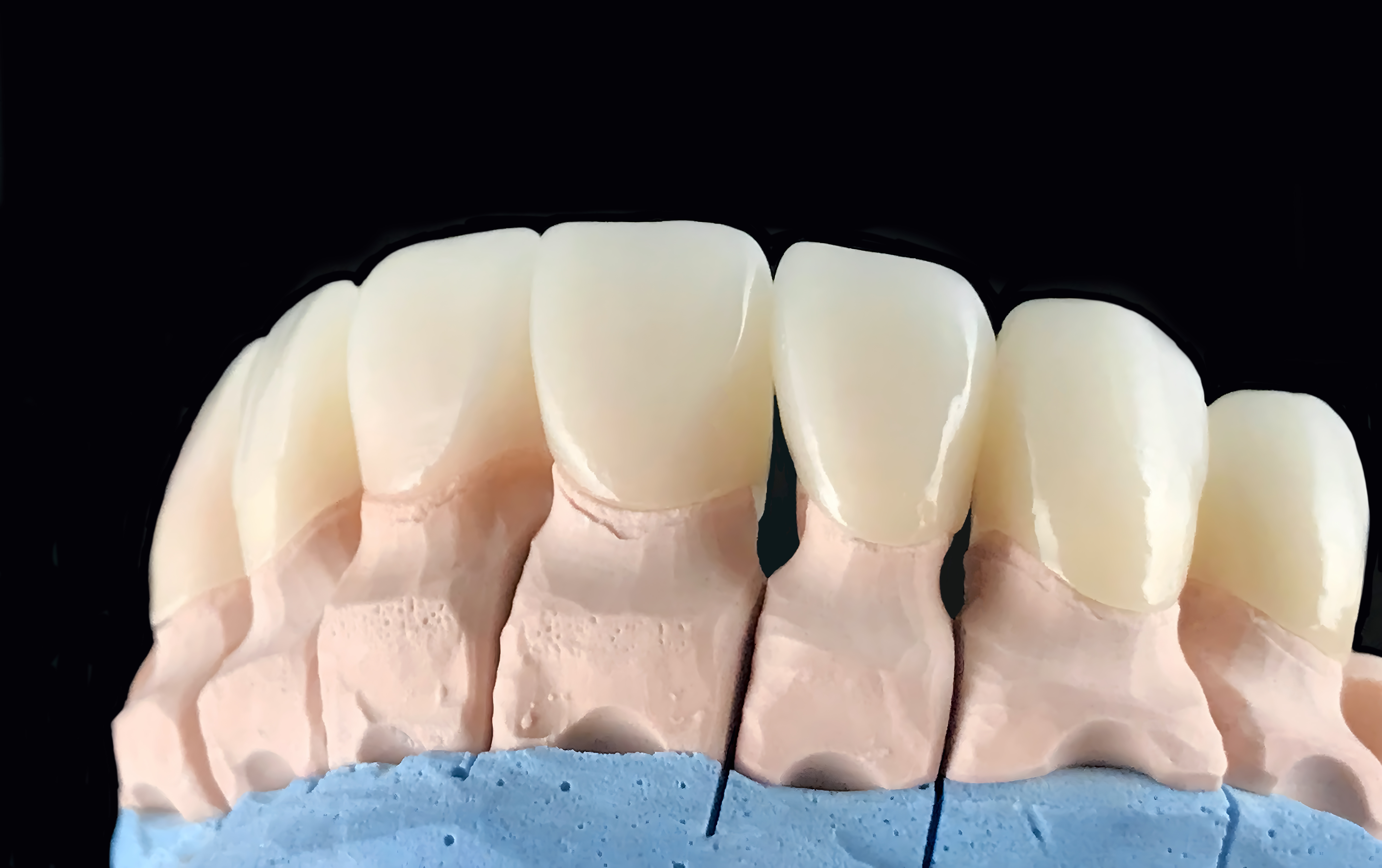 Natural look press ceramic veneers and crowns on dental plaster model. Close-up ceramic tooth crown
