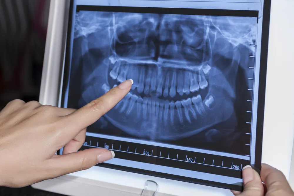 dental x rays