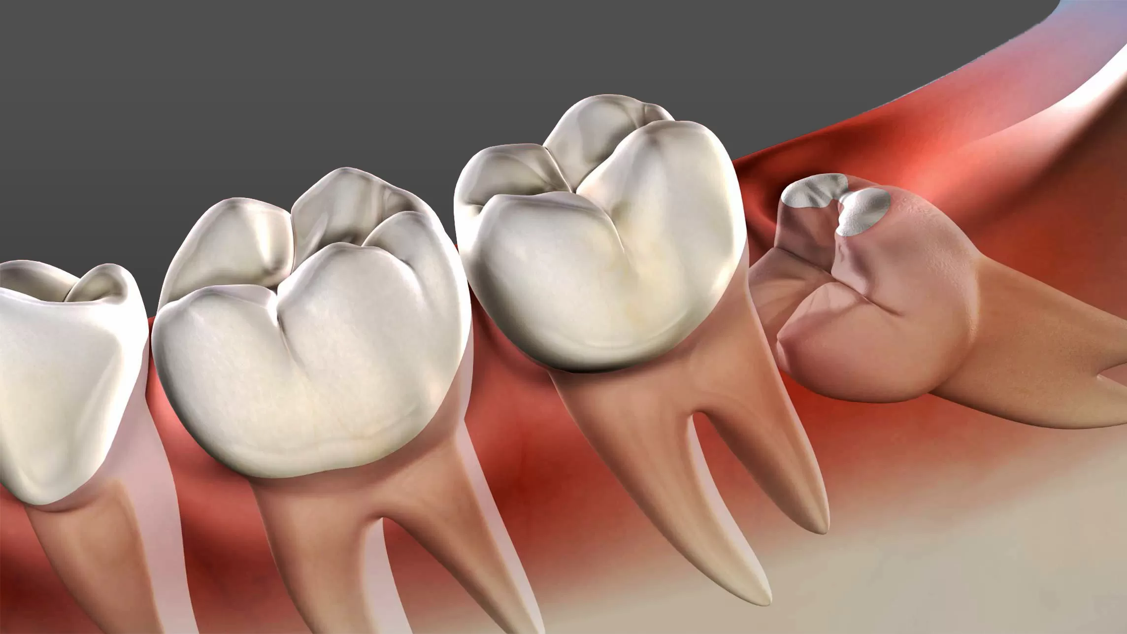 wisdom teeth