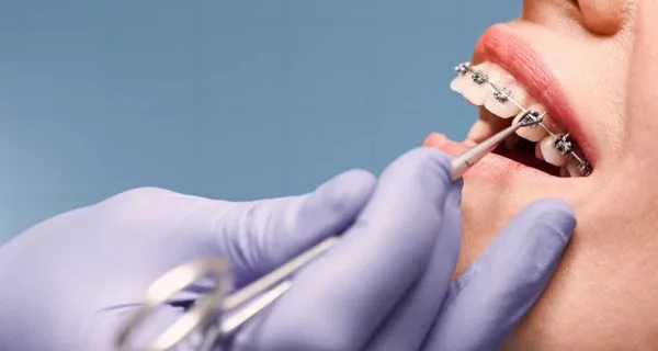 Can I start orthodontic treatment abroad and continue it at home?