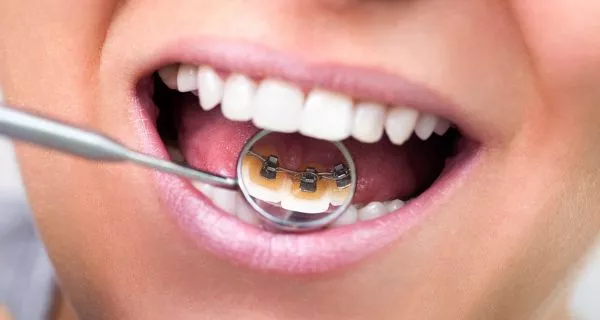 ¿Cuánto cuestan los diferentes tipos de brackets en Latinoamérica?