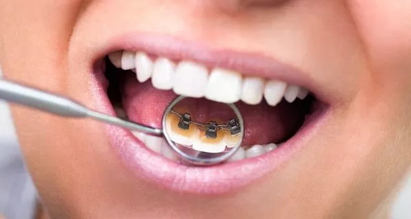 How much do different types of orthodontic braces cost in Latin America?