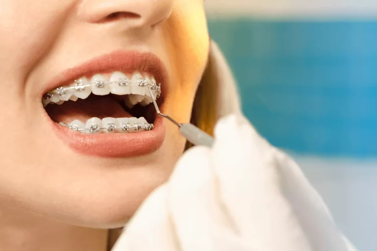 How much are orthodontic braces if done in Latin America?