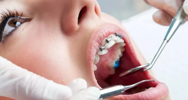 ¿Puedo iniciar mi tratamiento de brackets en el extranjero y continuarlo en mi país?