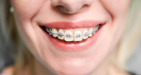 ¿Qué factores determinan cuánto cuestan los brackets?