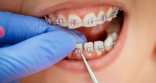 What factors determine how much orthodontic braces cost?