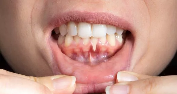 What is gum recession?