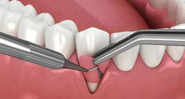 What is the pinhole gum graft?